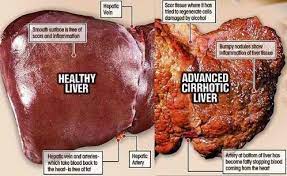 We did not find results for: Apakah Yang Dimaksud Dengan Sirosis Hati Ilmu Kedokteran Dictio Community
