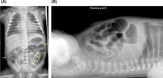 Image result for Necrotizing Enterocolitis