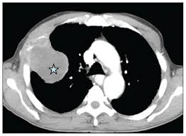 We did not find results for: Metastatic Malignant Pleural Mesothelioma Masquerading As A Case Of Acute Abdomen Secondary To Small Bowel Perforation Annals Of Saudi Medicine