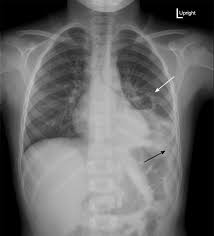Image result for Lung Abscess