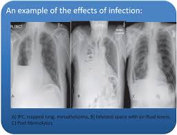 Loculated effusions occur most commonly in association with conditions that cause intense pleural inflammation, such as empyema, hemothorax, or tuberculosis. Infections In Invasive Pleural Procedures A Single Centre Experience