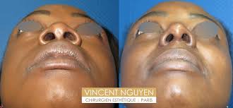 Découvrez les résultats de rhinoplastie réalisée par le dr smarrito rhinoplastie : Rhinoplastie Paris Chirurgie Esthetique Et Reparatrice Du Nez