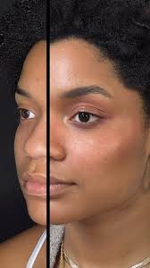 Lauren Padmore, Aesthetic Nurse Injector