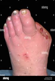 Image result for toe amputation
