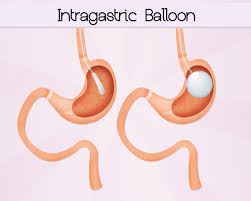 Originally used as the first stage of a gastric bypass procedure, it has become popular because a proportion of people maintain weight loss without needing to proceed to a gastric. Gastric Balloon New Body Specialist Bariatrics Australia