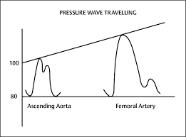 Image result for Pulse Pressure