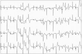 Image result for Exercise Induced Syncope