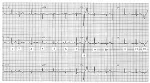 Premature ventricular contraction premature ventricular contractionclassification & external resources premature ventricular contraction in an premature ventricular contraction (pvc), also known as ventricular premature beat (vpb) or extrasystole, is a form of irregular heartbeat in which. Ecg Review How Many Pvcs 2005 11 15 Ahc Media Continuing Medical Education Publishing