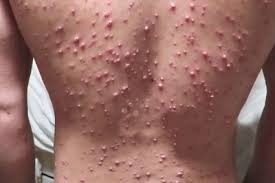 Petua ini dikongsikan oleh puan nurul aziyana: Chicken Pox Orang Dewasa Lebih Bahaya
