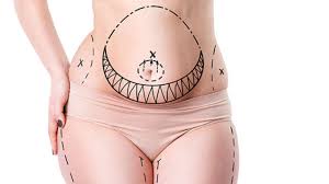 Am I A Good Candidate For Vaser Liposuction At Cosmos Clinic Sydney