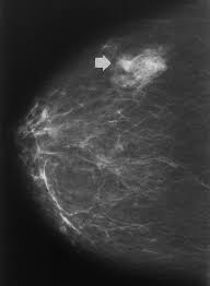What does cancer look like on a mammogram? Focal Asymmetric Densities Seen At Mammography Us And Pathologic Correlation Radiographics