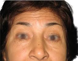 Blefaroplastia en Bogotá