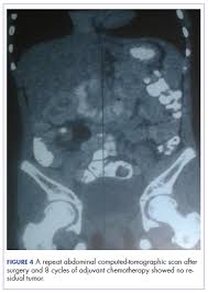 If gas and bloating are related to colon cancer, they tend to be late symptoms caused by an obstructing tumor in the colon. Carcinoma Of The Colon In A Child Mdedge Hematology And Oncology