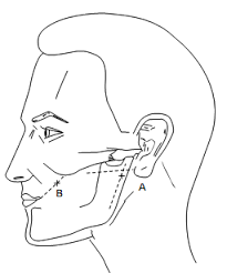 Chvostek sign or chvostek's sign is a clinical sign of hypocalcemia or low calcium level or tetany. Chvostek S Sign Wikidoc