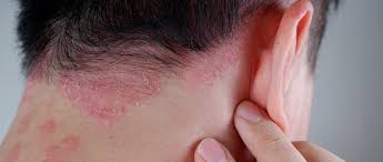 Image result for psoriasis