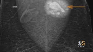 Lumps are most likely to be cancerous if they do not cause. Covid Swollen Lymph Nodes After Vaccination Could Lead To False Alarm On Breast Cancer Tests Ucsf Doctors Say Cbs San Francisco