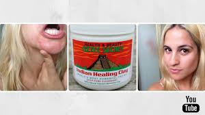 My First Experience With The Indian Healing Clay Mask Before After S Indian Healing Clay Indian Healing Clay Mask Healing Clay