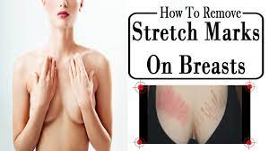 How To Remove Breast Stretch Marks Naturally Step By Steps