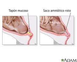 Tapon Mucoso En El Embarazo Que Es Y Cuando Se Produce Su Expulsion
