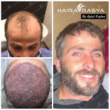 7500 Grafts 12 Months Perfect Result Of Our After The Hair Transplantation Hair Transplant Hair Implants Hair Clinic
