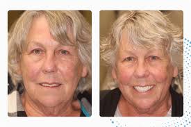 Dental Implant Before & After Photos