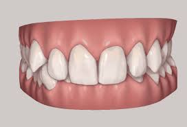 Well here's how invisalign® works. How Long Does Invisalign Take To Straighten Your Teeth Burwood Dental Care