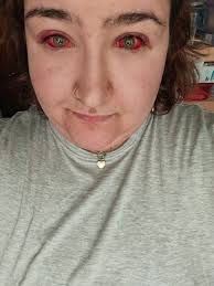 Definitely not half as bad as most things here but here is my most recent  health related problem.. Pink eye so severe nurses at the eye clinic were  stopping me to take