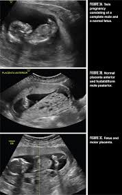 Hydatidiform Mole Recognition And Management Contemporary Ob Gyn
