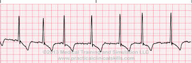 Atrial Rhythms Lessons And Quiz