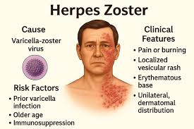 Image result for herpes zoster
