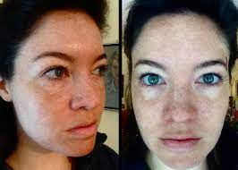 My Skin Story Week 1