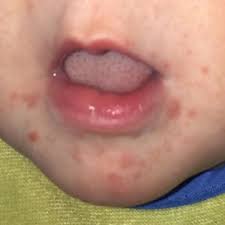 Types Of Baby Rashes Baby Rash Baby Rash On Face Rashes In Children