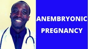 Can a blighted ovum cause anembryonic pregnancy? Hope Nursing Clinic Kampala Uganda Blighted Ovum Or Anembryonic Pregnancy What Is A Blighted Ovum Pregnant Without A Baby Empty Sac Facebook