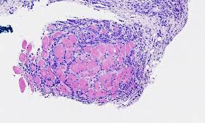 Speaking with a mesothelioma law firm is an important step for many. Pathology Outlines Mesothelioma Pleura Epithelioid