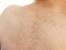 Hair On Breast Female Causes