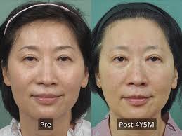 Abstracts of the ISAPS World Congress 2024, Cartagena, Colombia