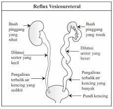If you want to learn pundi kencing in english, you will find the translation here, along with other translations from malay to english. Jangkitan Saluran Kencing Dalam Kanak Kanak