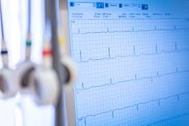 It is a graph of voltage versus time of the electrical activity of the heart using electrodes placed on the skin. Ruhe Ekg Praxen Kardiologie Kiel
