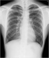 Sometimes, the lung may collapse without an apparent injury, called spontaneous pneumothorax. Case 1 A 20 Year Old Man Left Pneumothorax Lung Collapse Rate 3 9 Download Scientific Diagram