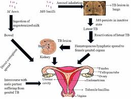 Image result for Genitourinary Tuberculosis
