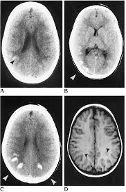 A Ct Scan On Initial Presentation Shows Faint Hyperdensity At The Download Scientific Diagram