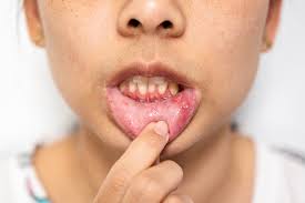 Image result for Canker sores roof of mouth