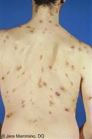 It usually appears as tumors on the skin or on mucosal surfaces such as inside the mouth, but tumors can also develop in other parts of the body (including the lymph nodes, lungs, or digestive tract).the abnormal cells of kaposi sarcoma cause purplish, reddish blue, or dark brown/black skin lesions. Kaposi S Sarcoma American Osteopathic College Of Dermatology Aocd