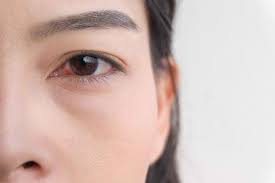 Meskipun mata tidak mengalami sakit, pedih atau penglihatan kabur , namun visual tompokan darah itu menunjukkan sepertinya mata anda terkena sesuatu. Mengenal Penyebab Mata Merah Alodokter