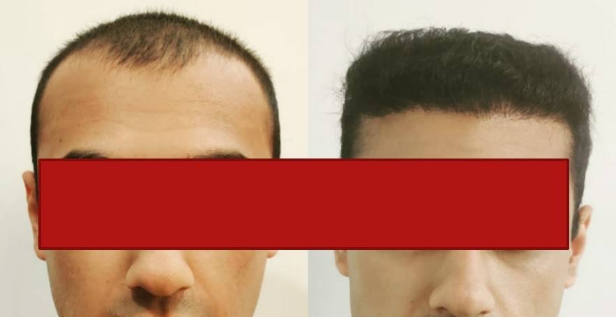 Hair Transplant product image