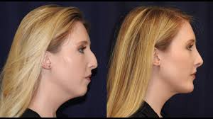 He inserts the tiny cannula through a small incision, and the smartlipo. Rhinoplasty Chin Lipo Chin Implant Patient Experience Nashville Plastic Surgeon Youtube