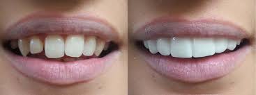 Do It Yourself Veneers Removable Veneers For Your Teeth