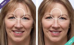 Silicone Scar Therapy for Instantly Concealing and Improving Scar's  Appearance