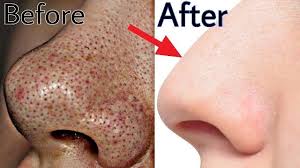 Les points noirs sont également très courants à l'âge adulte, notamment chez les personnes à peau grasse, mixte ou sujettes à l'acné. Les Points Noirs Sont Un Probleme De Peau Tres Commun Et Tres Derangeant Si Vous Cherchez Une Solution Definitive No Point Noir Probleme De Peau Tetes Noires