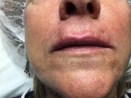 Un tel produit ne peut qu'être recommandé pour tous ceux qui souhaitent raffermir la peau du visage et retrouver la souplesse. Hyaluropen Avis Esthelis Restylane Juvederm Surgiderm Teosyal Derives D Acide Hyaluronique Forum Estheticon Fr